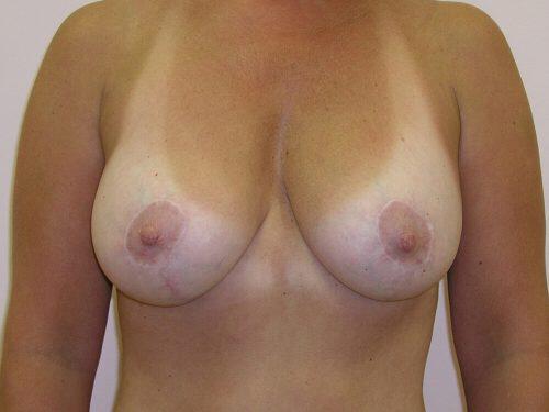 Breast Revision Before & After Image