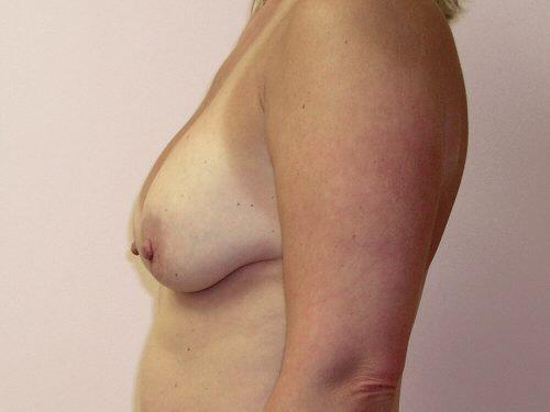 Breast Revision Before & After Image