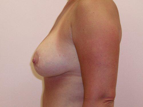 Breast Revision Before & After Image