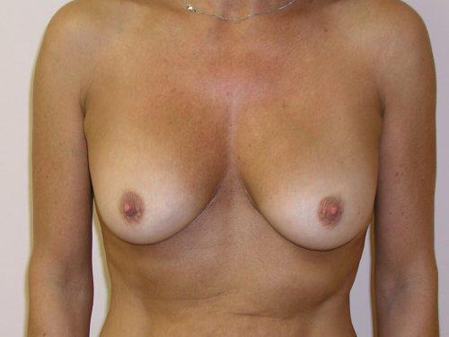 Breast Revision Before & After Image