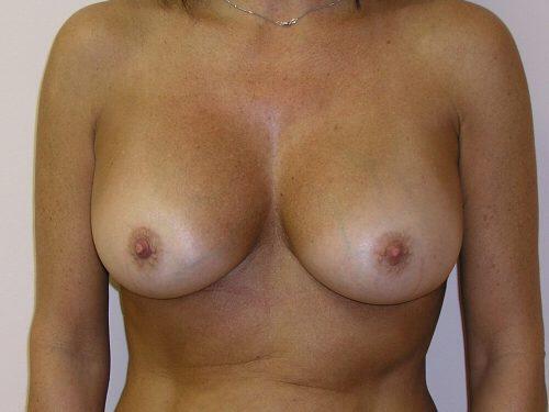 Breast Revision Before & After Image