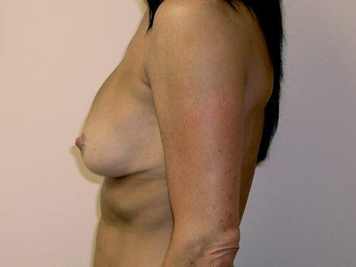 Breast Revision Before & After Image