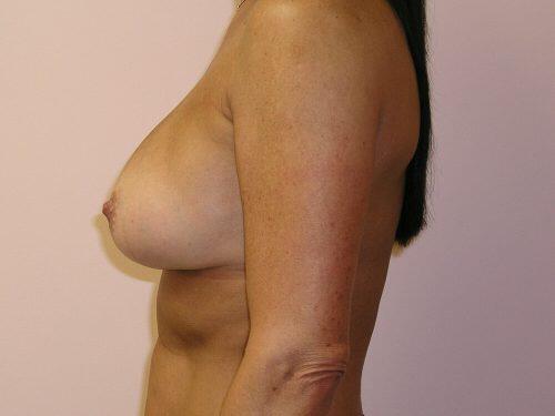 Breast Revision Before & After Image