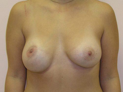 Breast Revision Before & After Image