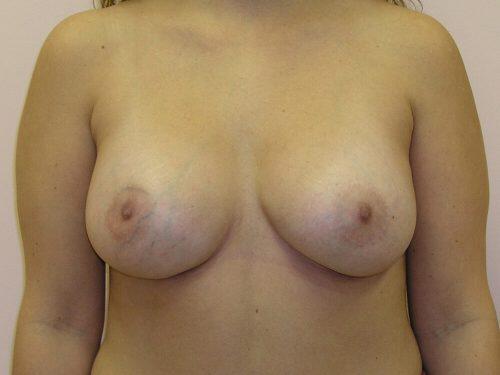 Breast Revision Before & After Image