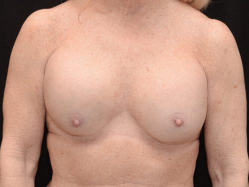 Breast Revision Before & After Image