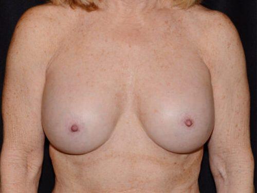 Breast Revision Before & After Image