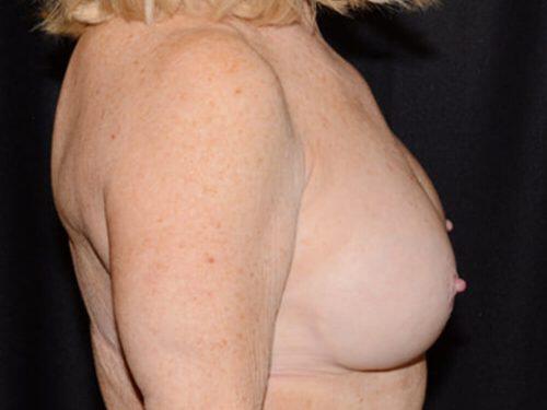 Breast Revision Before & After Image