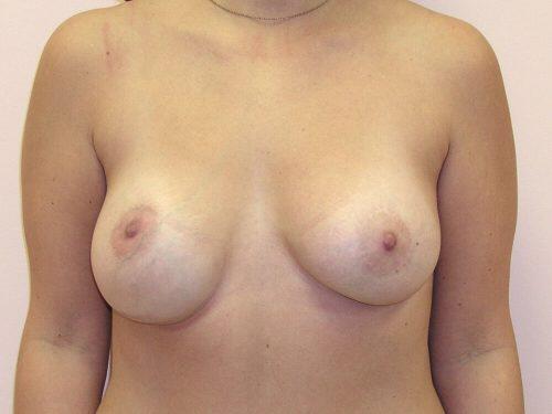 Breast Asymmetry  Before & After Image