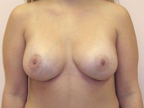 Breast Asymmetry  Before & After Image