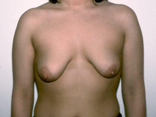 Breast Asymmetry  Before & After Image