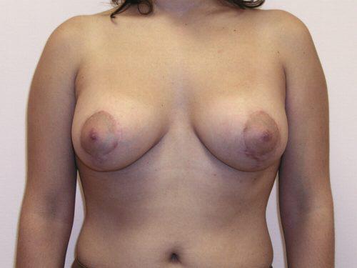 Breast Asymmetry  Before & After Image