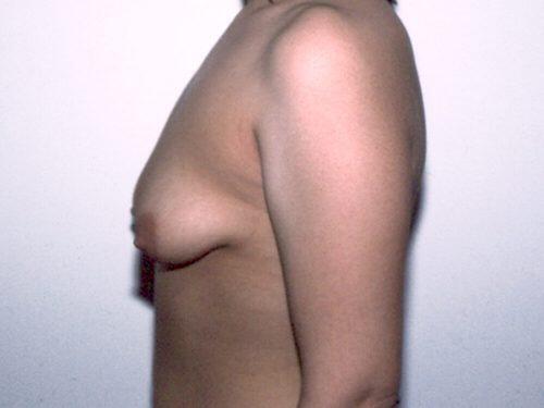 Breast Asymmetry  Before & After Image