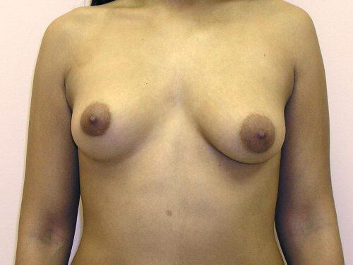 Breast Asymmetry  Before & After Image