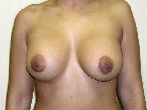 Breast Asymmetry  Before & After Image