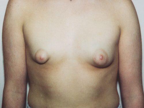 Breast Asymmetry  Before & After Image