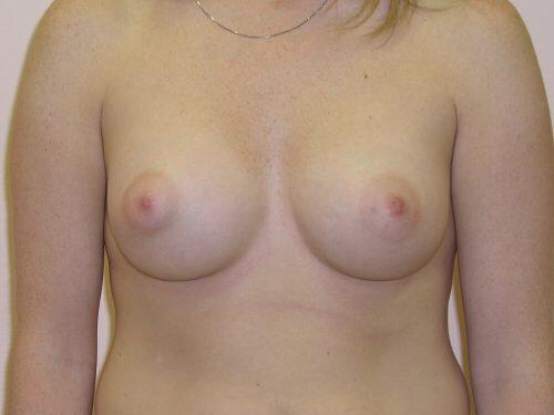 Breast Asymmetry  Before & After Image