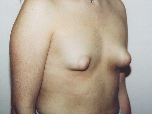 Breast Asymmetry  Before & After Image