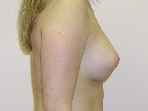 Breast Asymmetry  Before & After Image