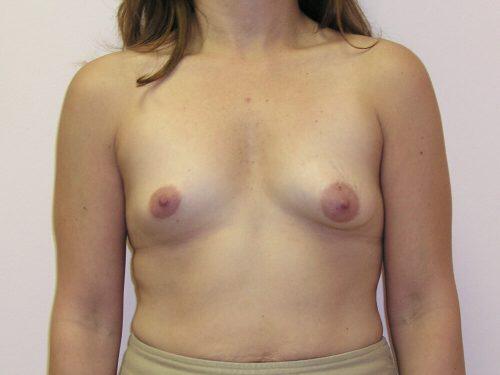 Breast Asymmetry  Before & After Image