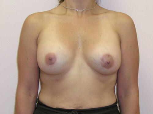 Breast Asymmetry  Before & After Image