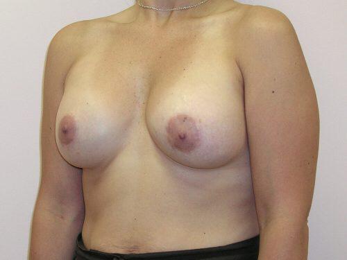 Breast Asymmetry  Before & After Image