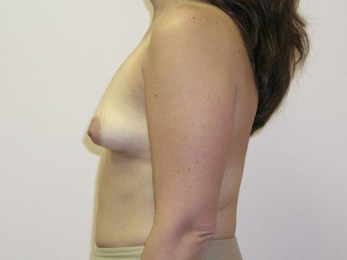 Breast Asymmetry  Before & After Image