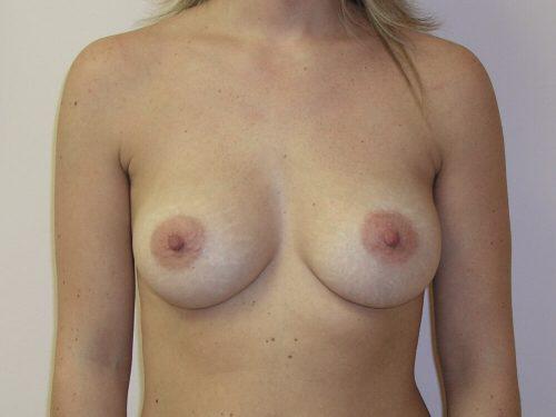 Breast Asymmetry  Before & After Image