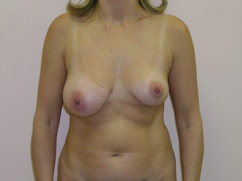 Breast Asymmetry  Before & After Image