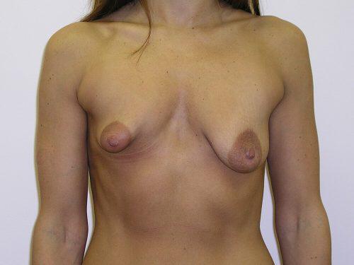 Breast Asymmetry  Before & After Image