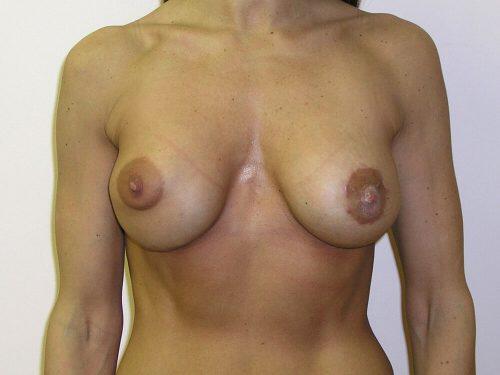 Breast Asymmetry  Before & After Image