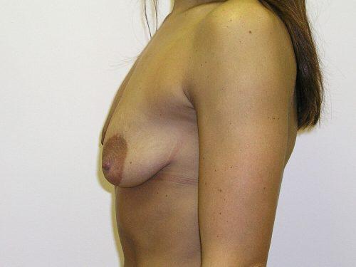 Breast Asymmetry  Before & After Image