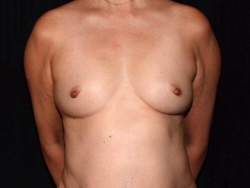 Fat Transfer Breast Augmentation  Before & After Image