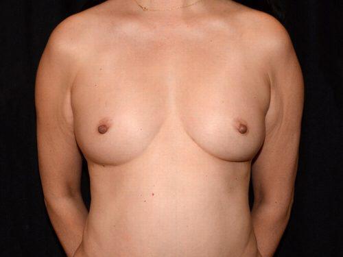 Fat Transfer Breast Augmentation  Before & After Image