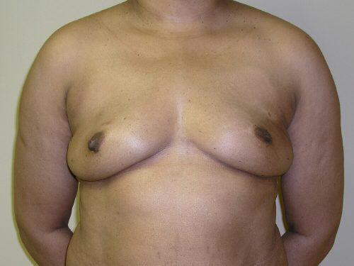 Fat Transfer Breast Augmentation  Before & After Image