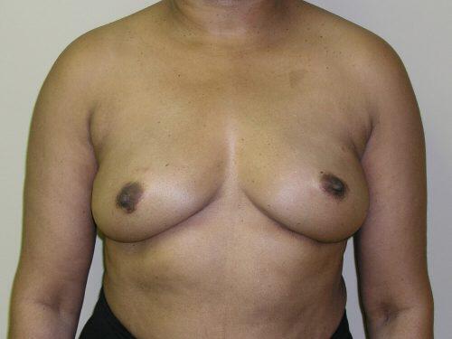 Fat Transfer Breast Augmentation  Before & After Image