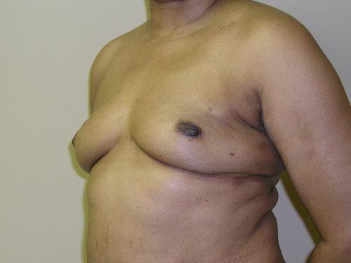 Fat Transfer Breast Augmentation  Before & After Image