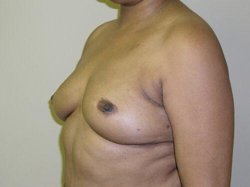 Fat Transfer Breast Augmentation  Before & After Image