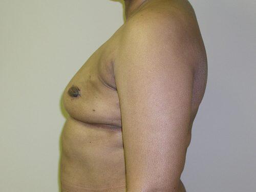 Fat Transfer Breast Augmentation  Before & After Image