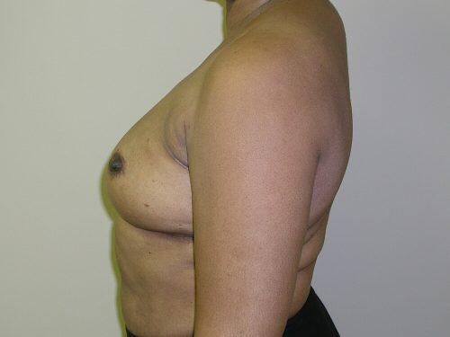 Fat Transfer Breast Augmentation  Before & After Image