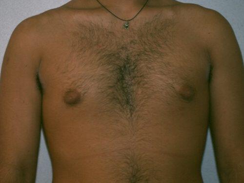 Gynecomastia Surgery Before & After Image