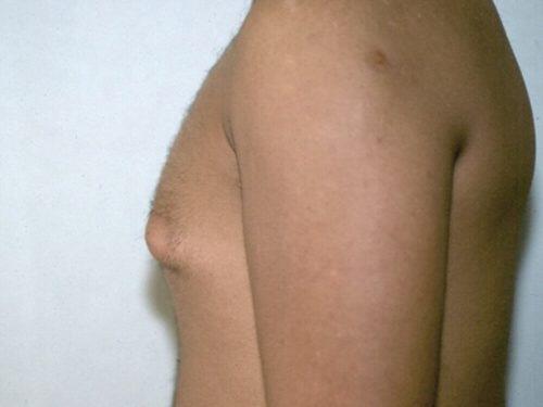 Gynecomastia Surgery Before & After Image