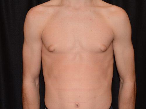 Gynecomastia Surgery Before & After Image