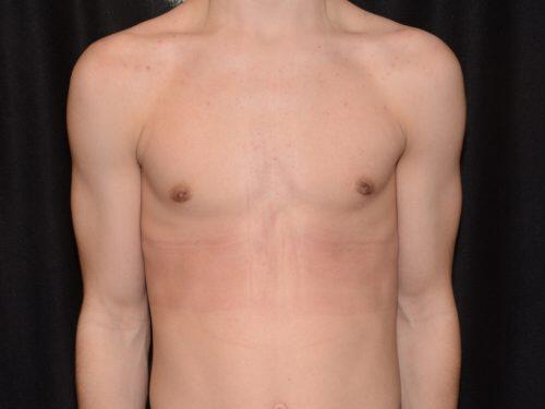 Gynecomastia Surgery Before & After Image