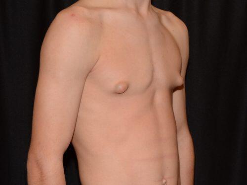 Gynecomastia Surgery Before & After Image