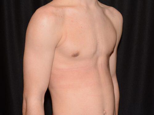 Gynecomastia Surgery Before & After Image