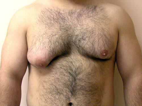 Gynecomastia Surgery Before & After Image