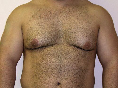 Gynecomastia Surgery Before & After Image