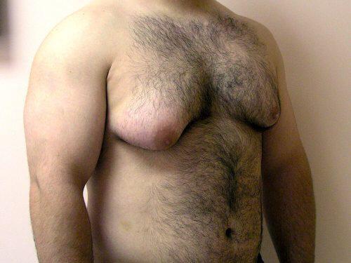 Gynecomastia Surgery Before & After Image