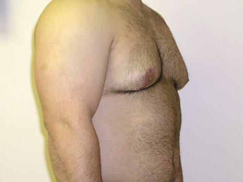 Gynecomastia Surgery Before & After Image